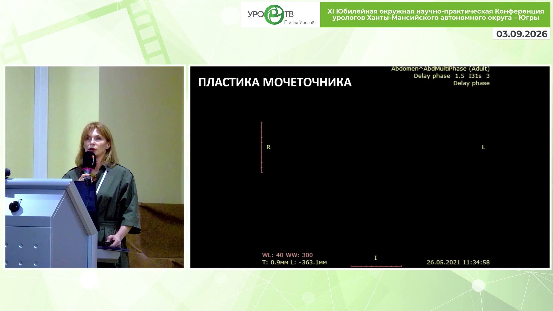 Наш опыт лапароскопической реконструкции стриктур мочеточника