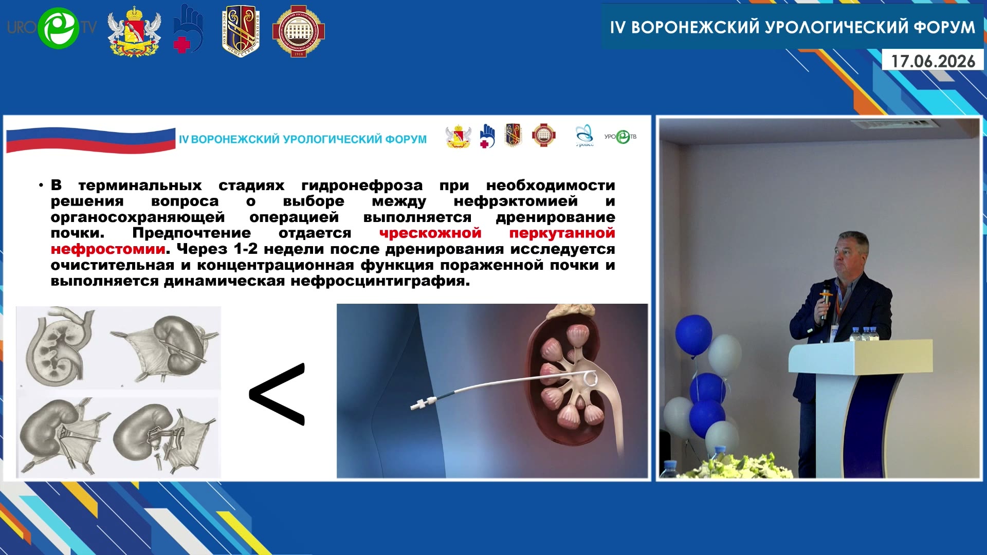 Фирсов О.В. - Наш опыт лапароскопического лечения аномалий мочевыводящих путей